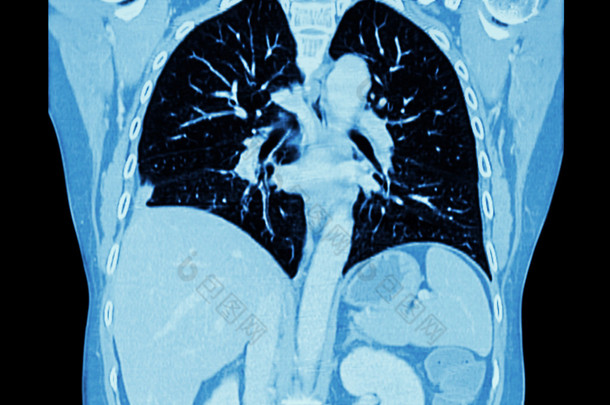 肺癌 （胸部和腹部 Ct 扫描 ： 显示右肺癌 ） （ 冠<strong>状</strong>平面 )