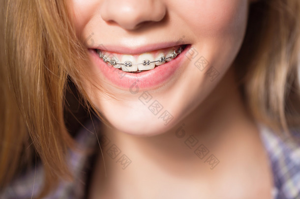 十几岁的女孩显示牙齿矫正的肖像.