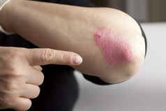 psoriasis sur coude