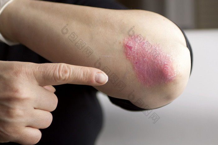 psoriasis sur coude