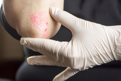 psoriasis sur coude