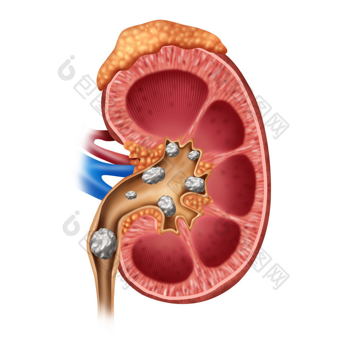 肾结石符号