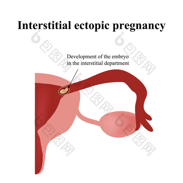 在间质部胚胎的发育。异位妊娠。信息图表。对孤立的背景图