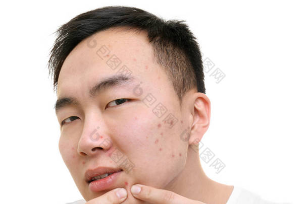 年轻亚洲人冒痘痘，白色背景上