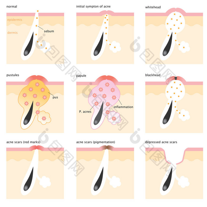 acne formation process