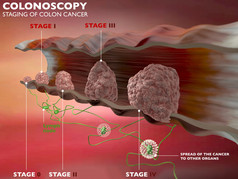 结肠癌的阶段