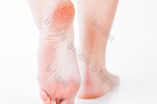 足部真菌和裂纹的脚跟