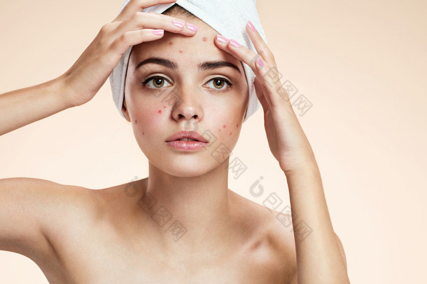 年轻的女士挤压她的粉刺，去除从她脸上的疙瘩。女人的皮肤护理概念