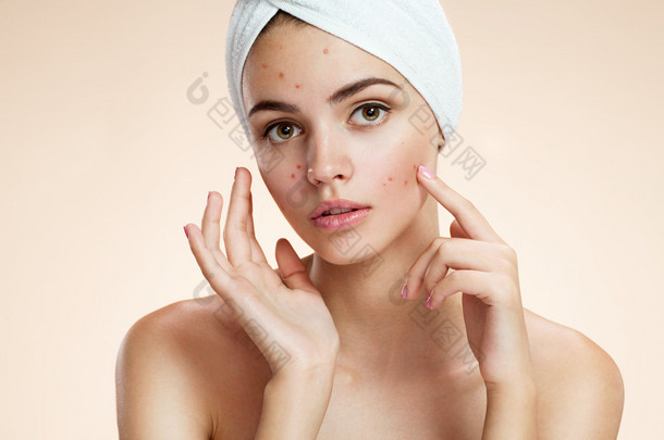 她用一条毛巾在她头上的粉刺板着脸秀的姑娘。女人的皮肤护理概念