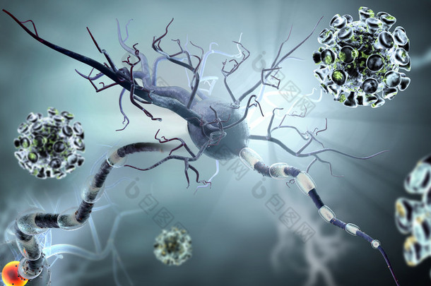 高质量三维图像处理病毒攻击神经细胞、 神经<strong>疾病</strong>、 肿瘤、 脑手术的概念.