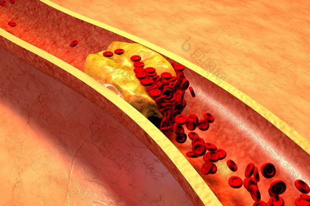 血小板与<strong>胆固醇</strong>斑块阻塞的动脉