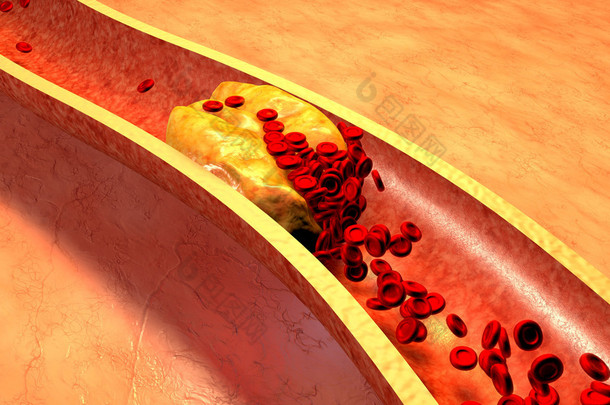 血小板与胆固醇斑块阻塞的动脉