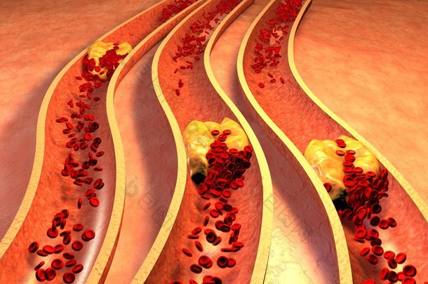 血小板与胆固醇斑块阻塞的动脉