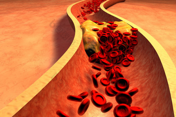 血小板与胆固醇斑块阻塞<strong>的</strong>动脉