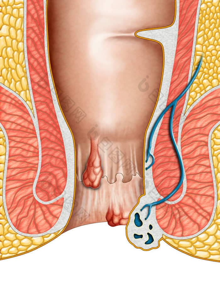 痔疮 肚皮