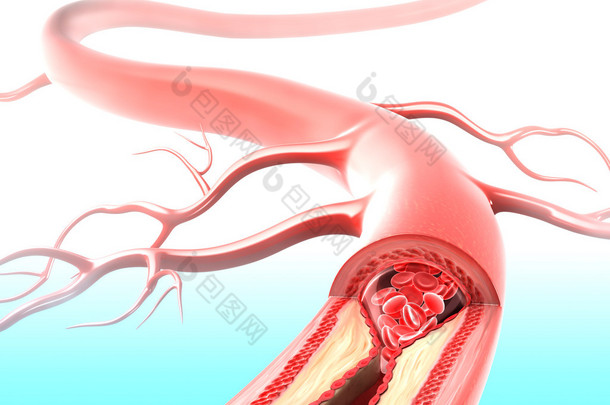 动脉粥样硬化的动脉引起胆固醇斑块