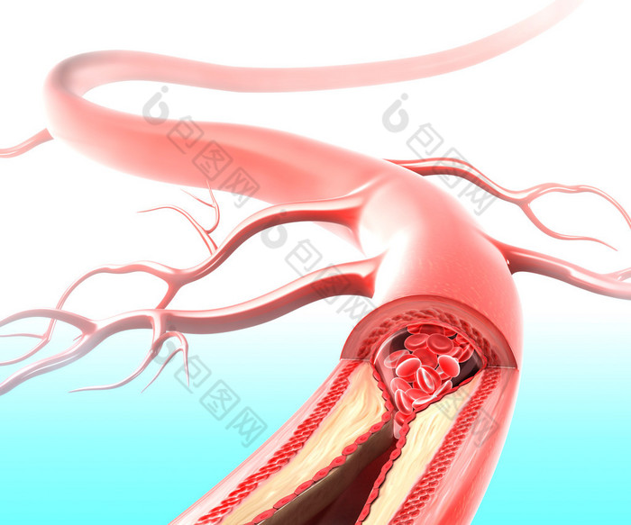 动脉粥样硬化的动脉引起胆固醇斑块