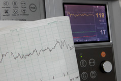 心电图固定和印刷的心率图