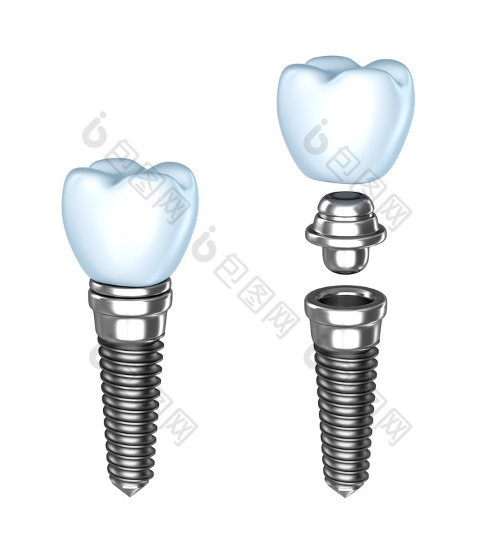 牙种植体。? ssembled 和拆卸。孤立对白色.