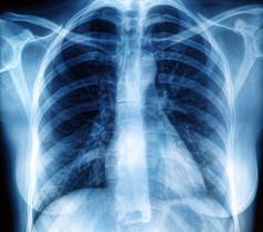胸部 x 射线图像