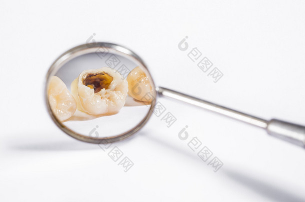 牙科植入物和假牙预防去看牙医