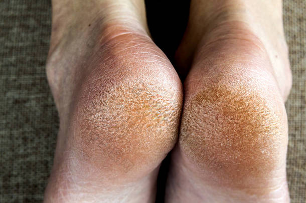 躺在床上的女人脚干燥开裂的皮肤。足部护理.