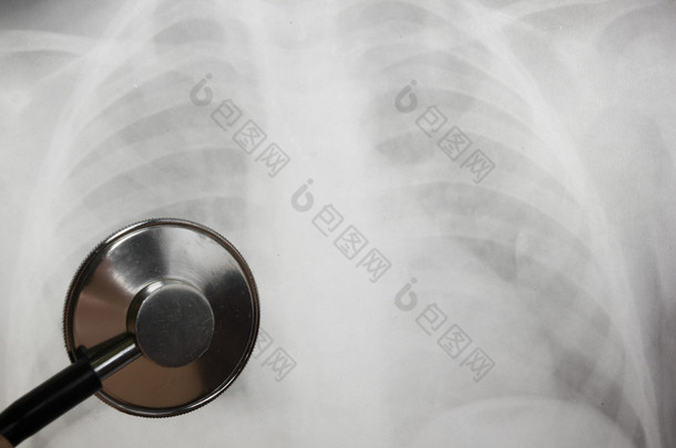 Medical stethoscope and x-ray or roentgen image. Close-up shot of lung radiography