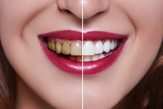 牙科治疗前后的妇女牙齿。牙齿美白。快乐的微笑的女人。牙科健康概念。口腔护理, 牙齿修复。坏牙.