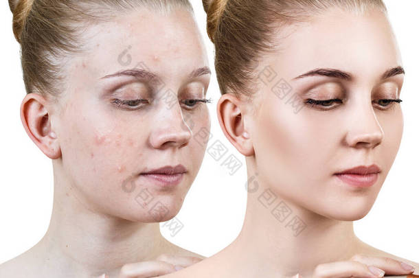 皮肤治疗前后的年轻妇女.