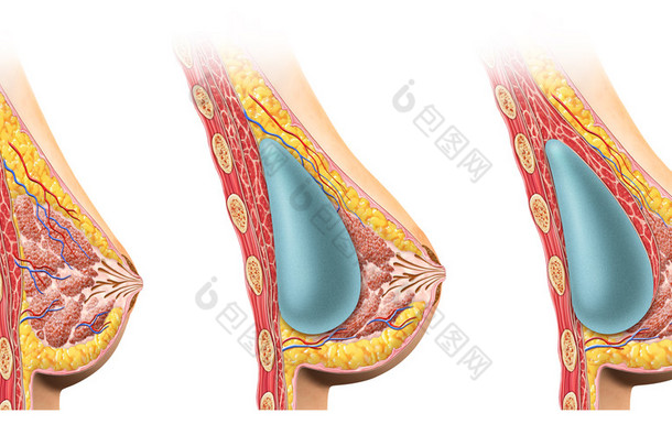 女人乳房植入物<strong>截面</strong>. 