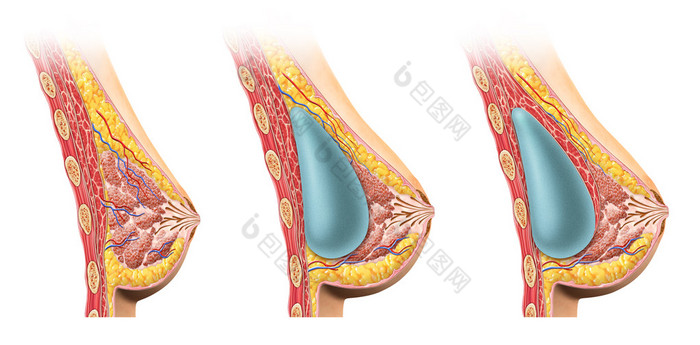 女人乳房植入物截面. 
