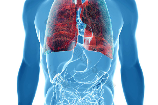  肺癌的 x 射线视图