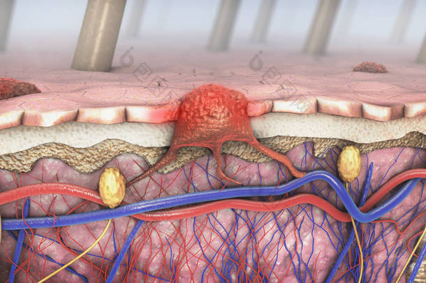 3d 说明一个病变<strong>皮肤</strong>的横截面与黑色素瘤进入血液和淋巴道