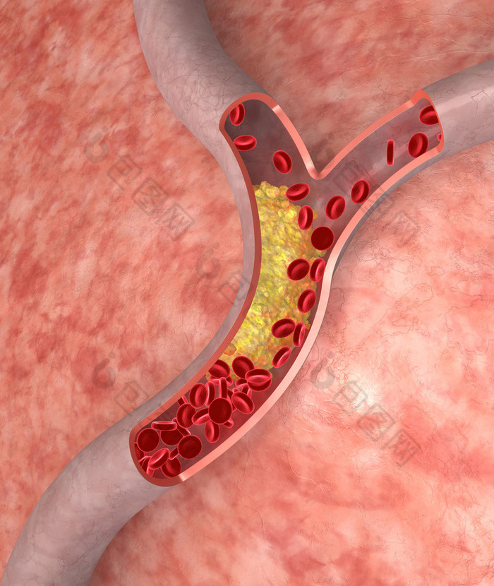 在动脉中胆固醇