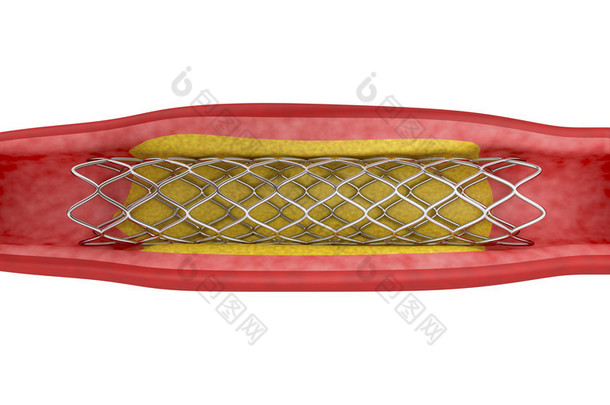 <strong>支架</strong>置换术的血管成形术