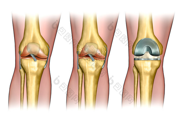 膝关节置换