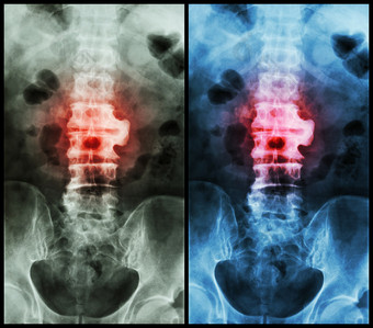 脊柱炎 （薄膜 X 射线腰椎 - 阴囊脊柱 ： 在 L2-3 显示脊柱炎 )图片