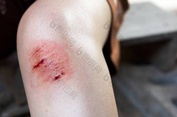 伤痕累累的<strong>伤口</strong>损伤对女人的膝盖背景