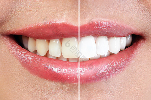牙齿美白结果论证<strong>之前</strong>, 和之后的程序。牙科学概念.