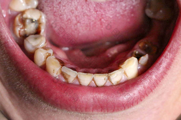 牙龈和牙周炎导致张嘴，牙齿破碎、疾病。牙龈中的钢<strong>销</strong>用于安装牙<strong>冠</strong>.吸烟者的牙齿上涂有尼古丁斑块.