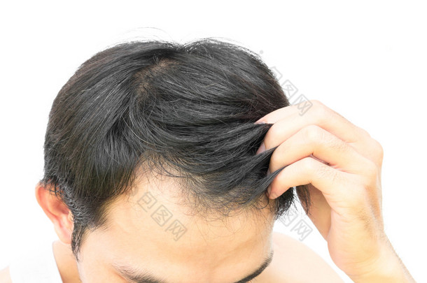 特写的年轻人严重脱发问题为<strong>白色</strong>背景上的头发损失概念或卫生保健洗发产品的
