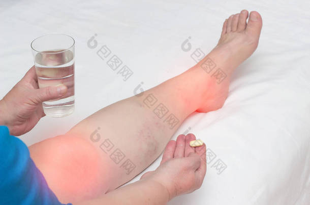 一个女人，她的腿在关节疼痛中保存着一颗<strong>药丸</strong>和一杯水。 抗炎药、维生素和软骨保护剂治疗关节炎和关节病的概念