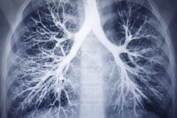 支气管镜检查图像。胸部 x 光检查。健康的肺