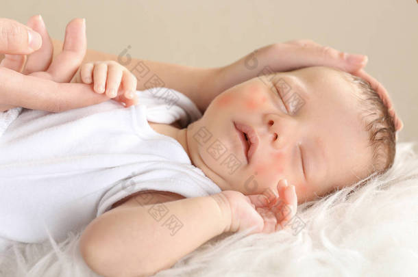 母亲双手<strong>抚摸</strong>着熟睡的小孩子, 红疹, 特写。婴儿过敏的概念