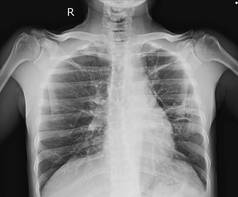 胸部 x 光片显示3厘米胸膜为基础的结节在上部叶, 具分裂的边缘。附近胸膜增厚。结节浸润在 rul. 正常的心脏大小。鉴别诊断钙肺、tb 肉芽肿.