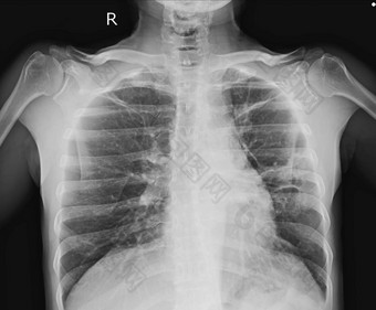 胸部 x 光片显示3厘米胸膜为基础的结节在上部叶, 具分裂的边缘。附近胸膜增厚。结节浸润在 rul. 正常的心脏大小。鉴别诊断钙肺、tb 肉芽肿.图片