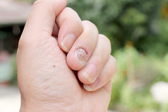 指甲手真菌感染, 手指与甲真菌病, 脚趾甲真菌。-软对焦