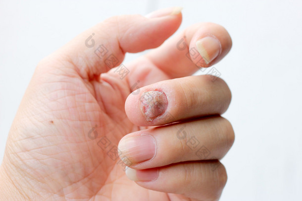 真菌<strong>感染</strong>对指甲的手，手指与甲真菌病。-软焦点