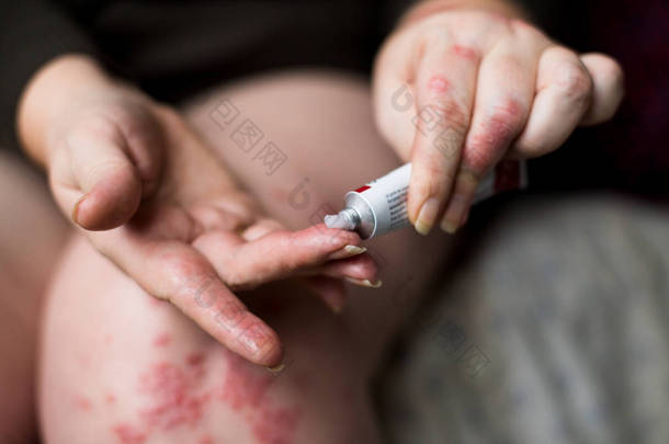 在治疗牛皮癣, 湿疹和其他干燥的皮肤条件下, 应用润肤剂干燥片状皮肤。妇女应用奶油手臂, 瘙痒, 概念与医疗保健和医学.
