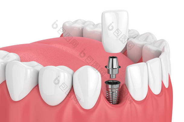 3d. 用牙齿和牙牙种植体进行颌骨的渲染